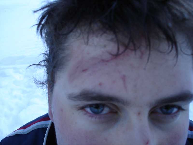 Das bin ich nach dem ,,Sturz&amp;quot;; War schlimmer als es aussieht